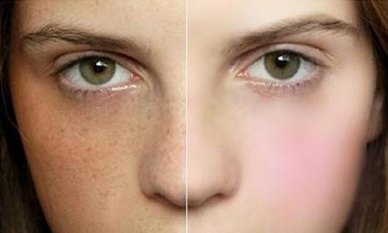 Quy -trình-trị-tàn nhang-Thẩm-mỹ-An-Thái