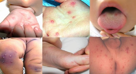 Cach-phat-hien-som-va-cham-soc-tre-bi-tay-chan-mieng-thammyanthai.vn