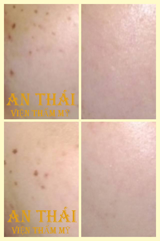 Tri-tan-nhang-Thammyanthai.vn