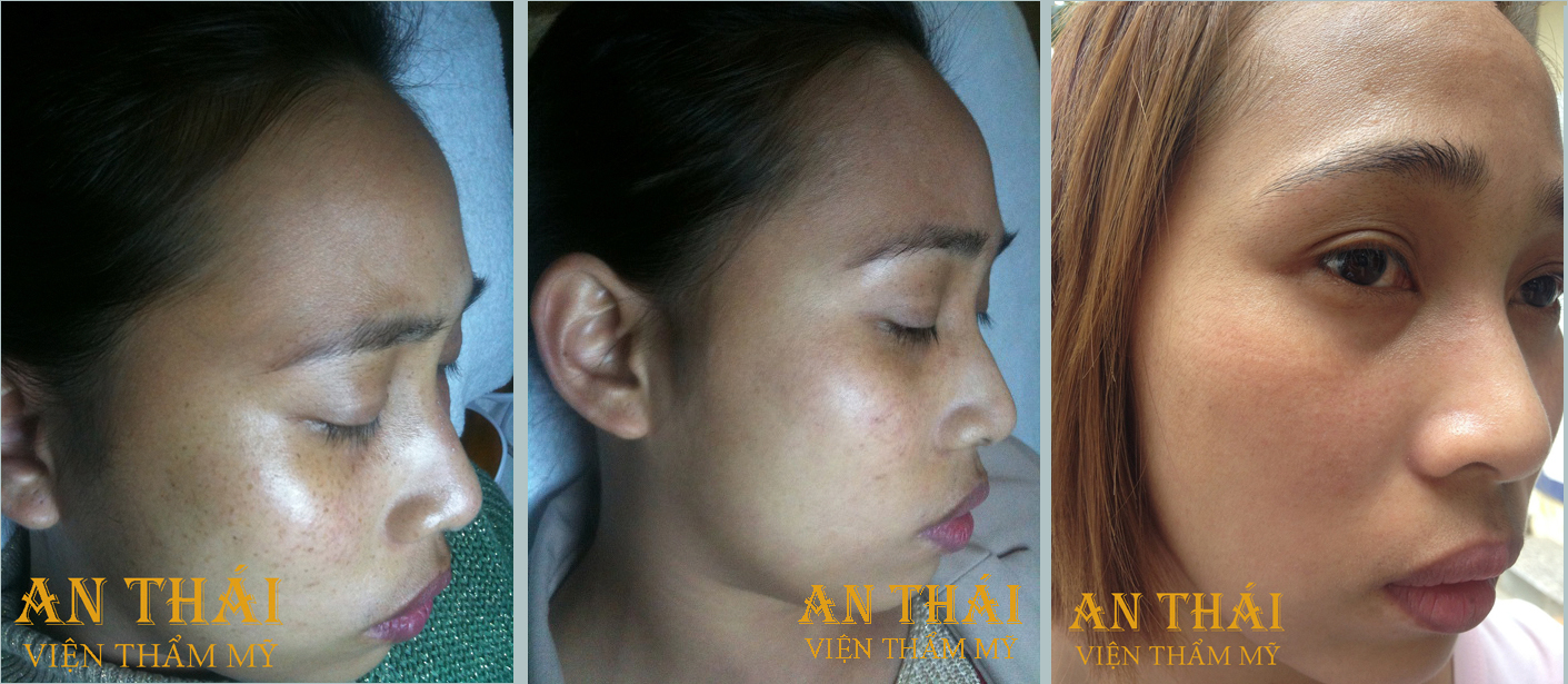 Cach-tri-tan-nhang-nhanh-nhat