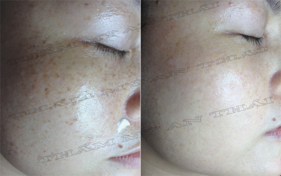 Trị tàn nhang - Thẩm mỹ An Thái