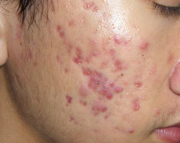 Tự trị mụn