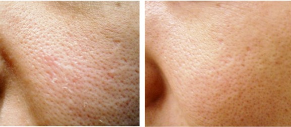 Thu nhỏ lỗ chân lông