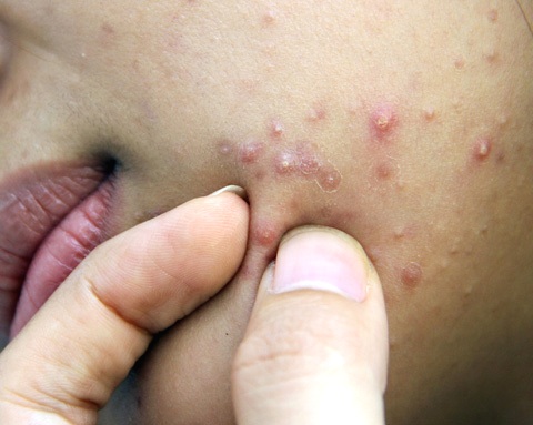 trị mụn trứng cá tận gốc