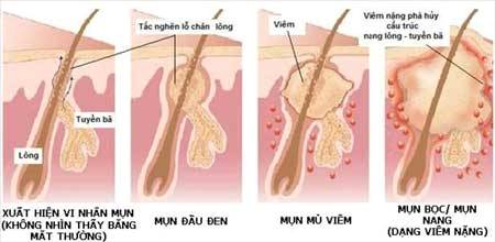 cơ chế hình thành mụn trứng cá